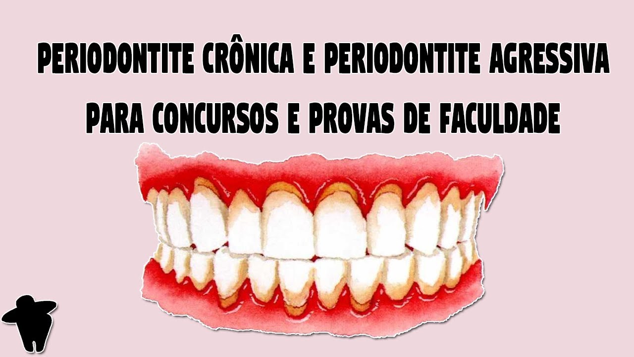 Qual O Cid De Doenças Periodontais?