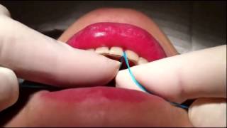 IDontix X Floss Lite -  Dental Shop 4 You