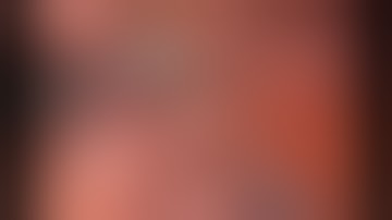 Robotic left lateral segment liver resection