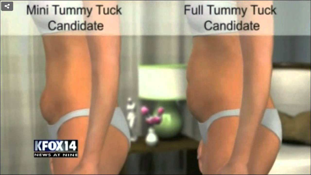 Dr. Ozan Sozer - El Paso Cosmetic Surgery Moderate Weight Loss Part II KFOX-TV