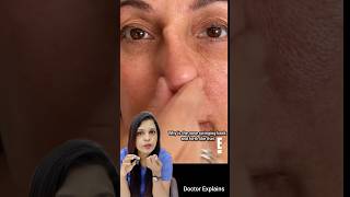 Silicon implant in Rhinoplasty #doctoradvice #drnalliramya #telugudoctor #ent #rhinoplasty #health