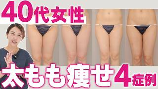 40代で脂肪吸引はたるむ？症例写真でBMI・体型が違う4人の…のサムネイル
