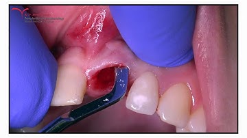 Immediate Implant Placement V3 MIS - Comp.Guided Surgery, Allograft, Mucoderm(Botiss)