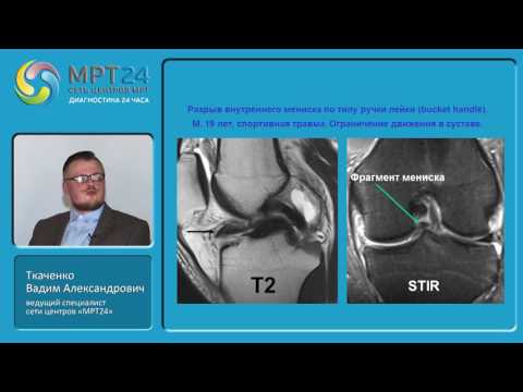 Video: Osteoartróza Rentgenů Kolen