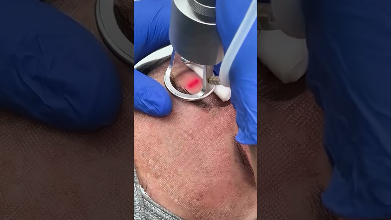 Co2 laser treatment #usa #skincare #satisfying #acnetreatment #blackheads #laser #skin #uk #peeling