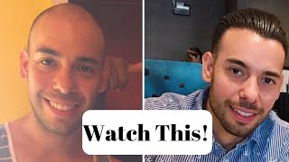 Detailed ⚠️5 Things You Should Know Before Having A Hair Transplant Details