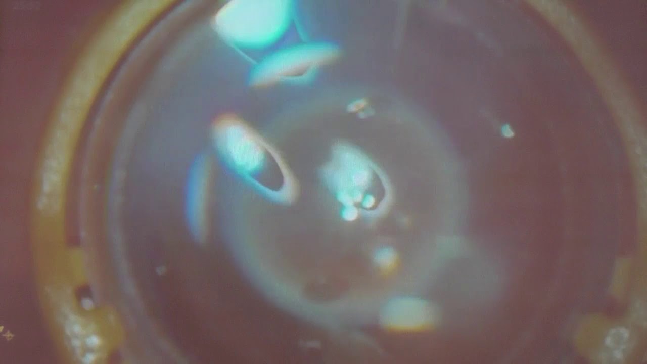 Оперативное лечение пролиферативной диабетической ретинопатии - YouTube