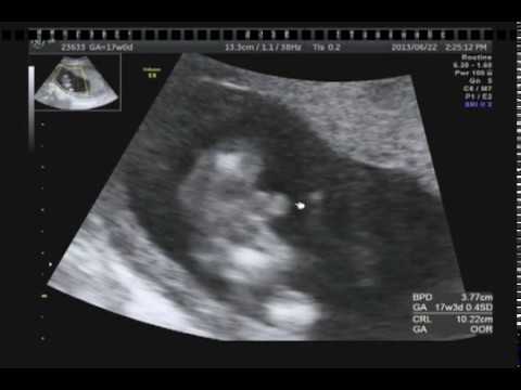 発覚 妊娠17週 エコーにて大変な ツイてるw 事実が判明 Baby17week Ultrasonography 生まれる前のもっちゃん動画 ベビちゃんねる 赤ちゃん成長記録動画 Youtube