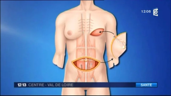 Reconstruction mammaire avec la mthode DIEP