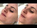 Obagi Blue Peel, Rejuvenate and Refresh your Skin!
