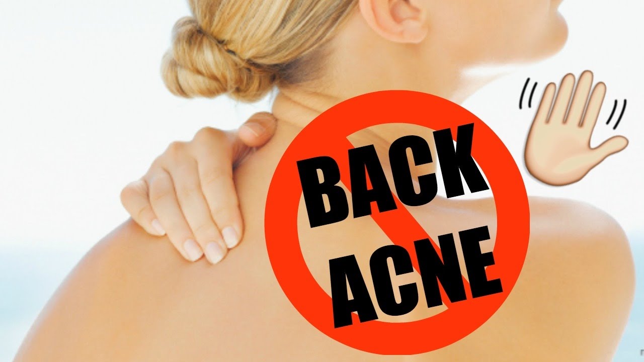 How to Get Rid of Body Acne + DIY Apple Cider Vinegar Toner! - YouTube