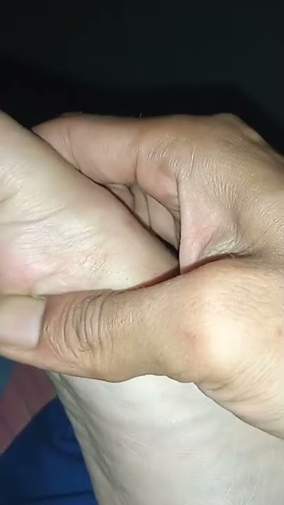 Cara benar memijat titik buang angin dalam lambung agar cepat buang angin ( KENTUT)