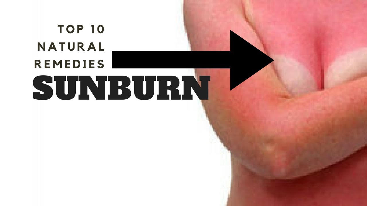 Discussion on this topic: 6 Home Remedies to Soothe a Sunburn, 6-home-remedies-to-soothe-a-sunburn/ Forum on this topic: 6 Home Remedies to Soothe a Sunburn, 6-home-remedies-to-soothe-a-sunburn/
