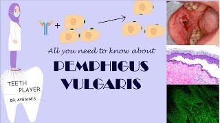 PEMPHIGUS VULGARIS | CLINICAL PRESENTATION- DIAGNOSIS- TREATMENT | ANIMATED ORAL PATHOLOGY NOTES screenshot 3