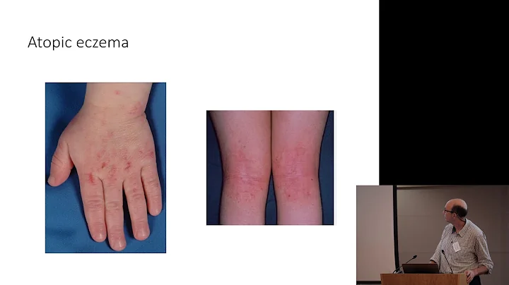 Eczema - Dr Richard Weller