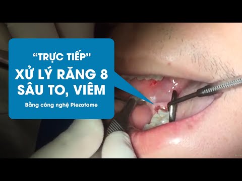 Nhổ răng 8 sau to gây hôi miệng | Đại tá Bs Nguyễn Qúy Tuệ