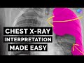 Chest X Ray Interpretation How To Read A CXR OSCE Guide UKMLA CPSA PLAB 2