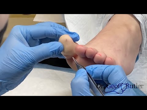 Cyst removal.