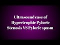 Another case study of hypertrophic pyloric stenosis