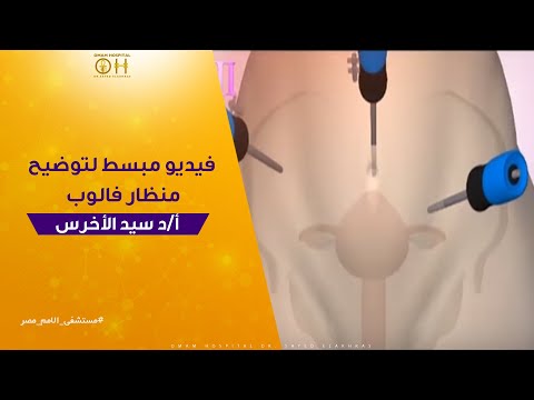 فيديو: ما هو استئصال البوق الثنائي بالمنظار؟