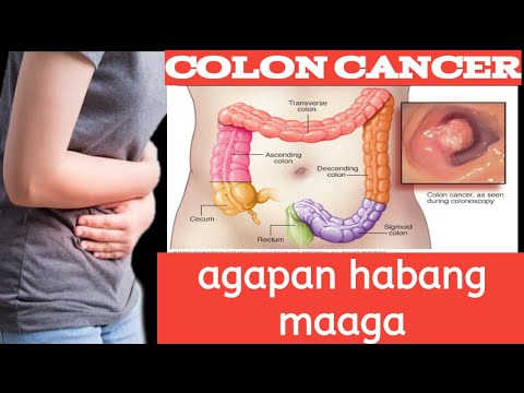 Signs and Symptoms of colon cancer | Health Tips #shorts