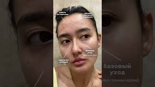 5 секретов лечения акне до чистой кожи ⬇️ #акне #косметологмосква #skincare #дерматолог