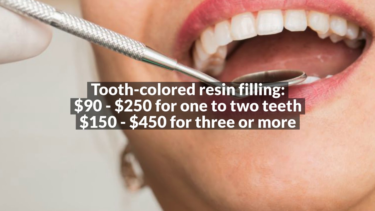 How Much Will a Cavity Filling Cost for Your Child Without