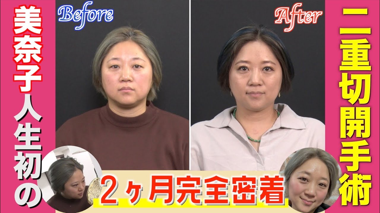 【整形ドキュメント】大家族の母・美奈子人生初の「二重切開手術」に完全密着