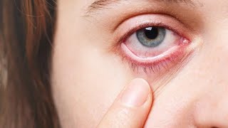 Eye flu //Eye hone pr kya kren// eye flu home treatment in hindi