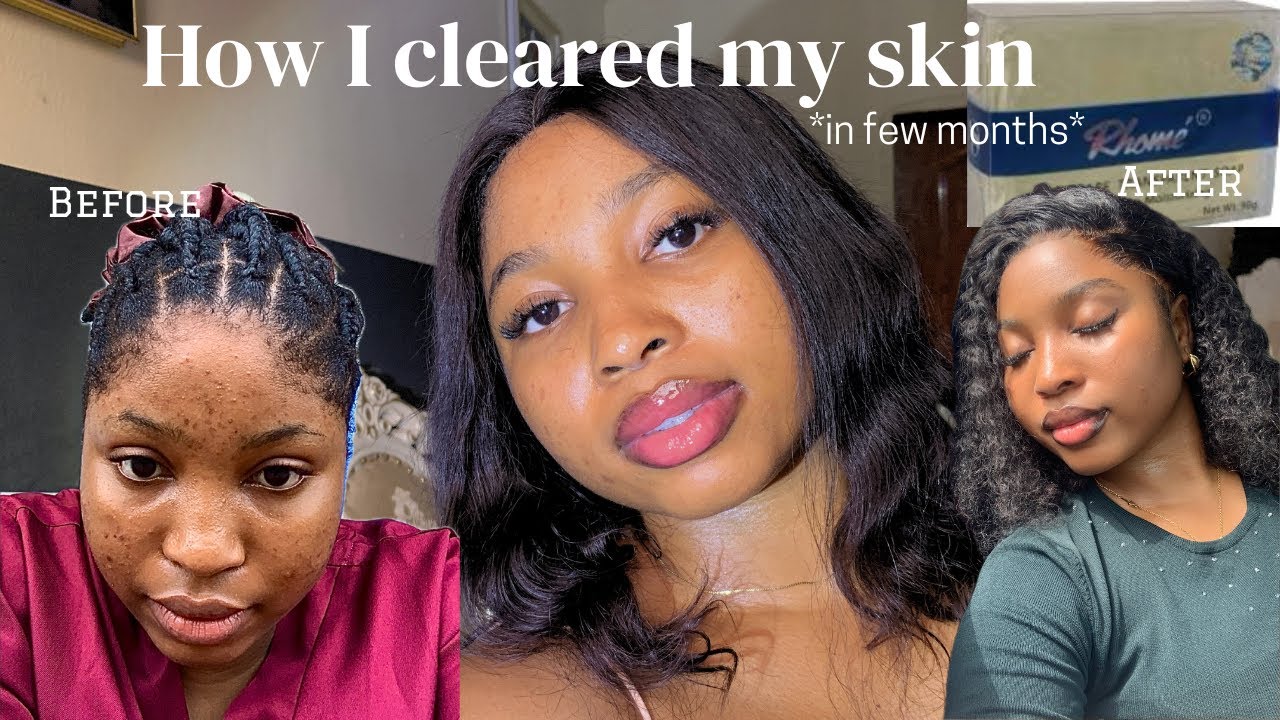 How I cleared my skin with few products | sensitive skin friendly ...