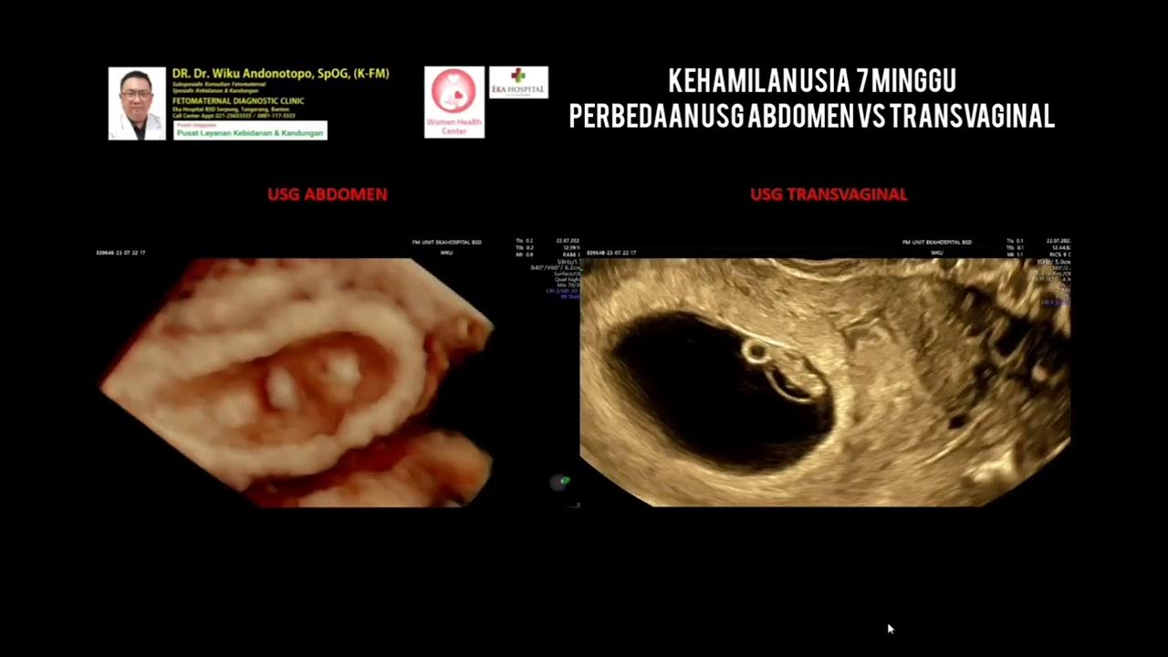 Ginekologik transvaginal ultratovush namunasi