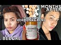 Treating my Hormonal Cystic Acne with Spirolactone | (4 MONTHS) Before & Afters + Pros/Cons