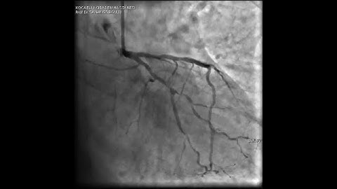 CX bifurcation lesion (Successful Culotte intervention step by step).video 1