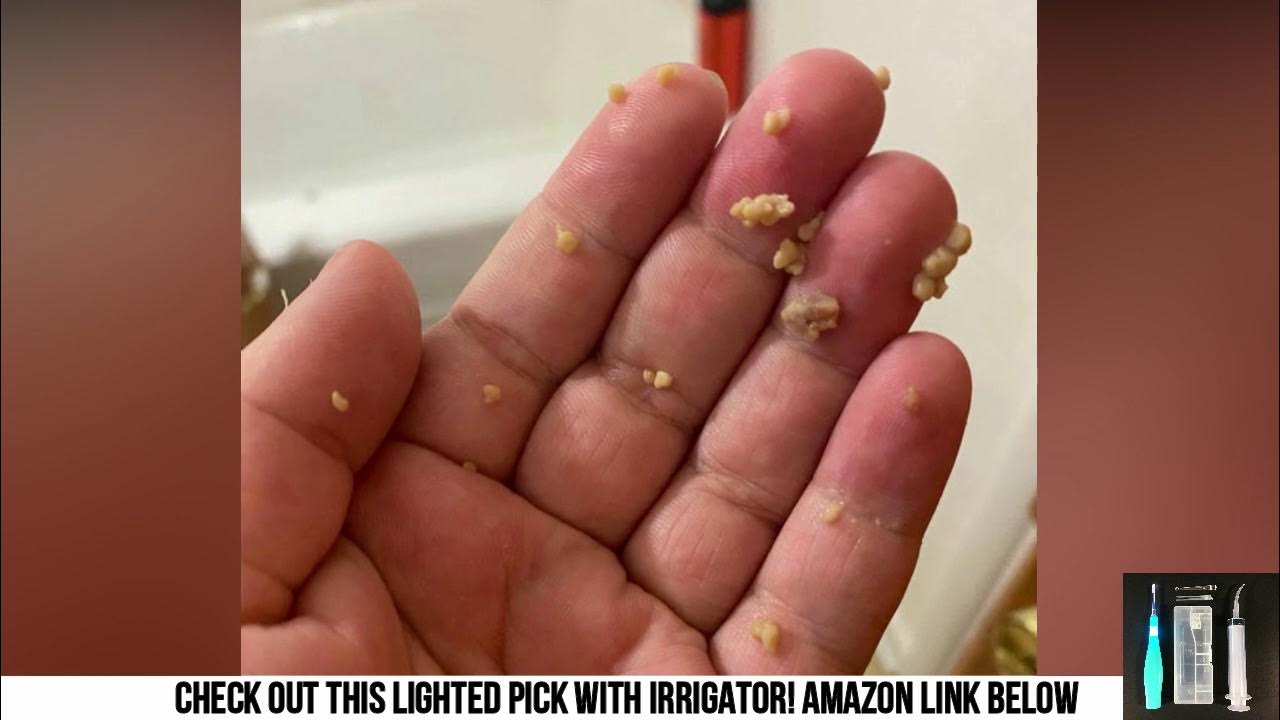 World's Largest Tonsil Stones! Tonsil Stone Removal YouTube