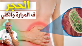 الحصى أو الحجر في المرارة والكلي نصائح الدكتور عماد ميزاب Docteur Imad Mizab