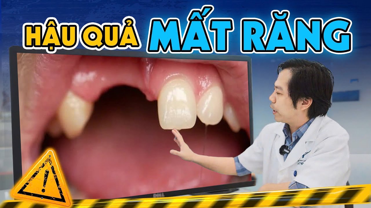 Outline Video Mất Răng Không Trồng Lại Có Sao Không? 3 Hậu Quả NẶNG NỀ Của Mất Răng Cần Cảnh Giác