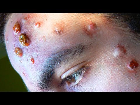 Worst Cystic Acne, Thick Whiteheads & Blackhead Removal! 💯💯💯