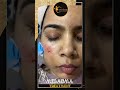 Melasma Treatment at Asthederm (Aesthetics by Jasmine)