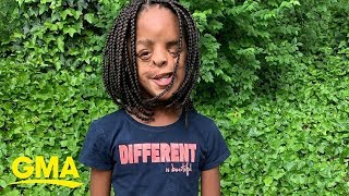 11-year-old girl teaches valuable lesson about embracing what makes your different | GMA Digital