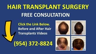 Before and After Hair Transplant Surgery Coral Gables