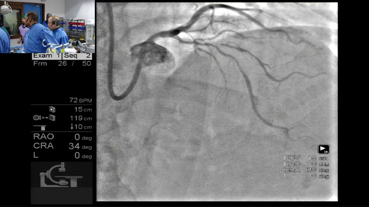 A complex LAD diagonal bifurcation case by Dr. Shigeru Saito