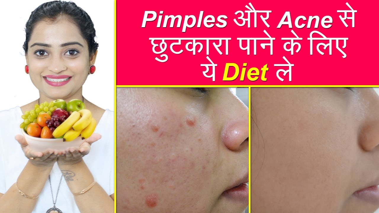 मुहासों से छुटकारा पाने के लिए ये डाइट ले Diet to Remove Pimples
