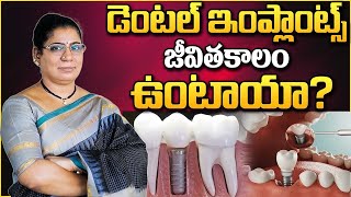 డెంటల్ ఇంప్లాంట్లు జీవితకాలం ఉంటాయా.? | Dr.Shailaja Reddy | FMS Dental | Best Dental Implantologist