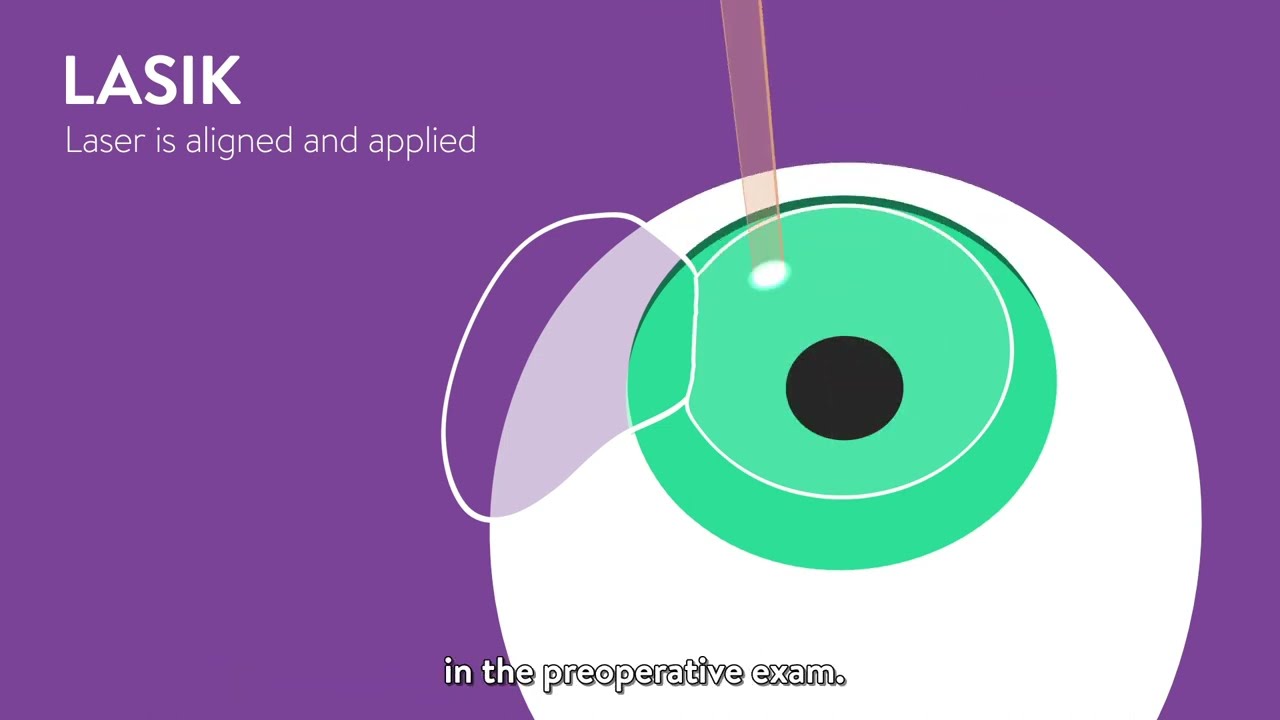 Comparing Vision Correction Procedures: LASIK, PRK, SMILE, and EVO ICL™ Explained