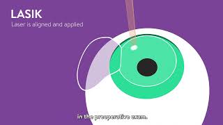 Comparing Vision Correction Procedures: LASIK, PRK, SMILE, and EVO ICL™ Explained