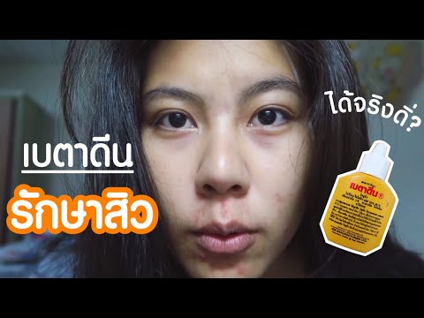 [Howto] รักษาสิวด้วยเบตาดีน ฉบับ.ทดลองเอง | Jewarin mt.