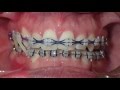 Orthodontic Transformation from Start to Finish