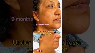 She looks so natural!!! Facelift and Neck Lift before and after #shorts #facelift #necklift