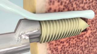 Eclipse soft tissue anchor, manufactured and submitted by MedShape Inc USA