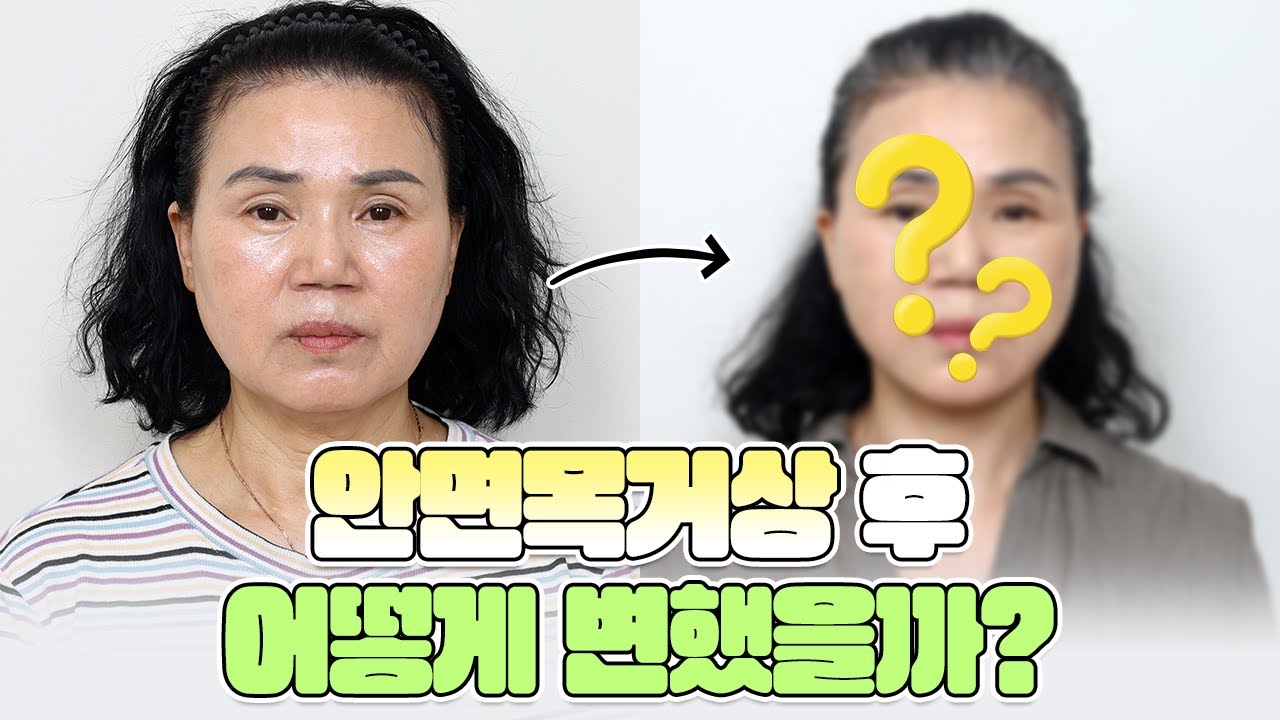 50대 후반 여자 안면거상, 팔자 심부볼 처짐과 인상까지 한 번에 개선🥰